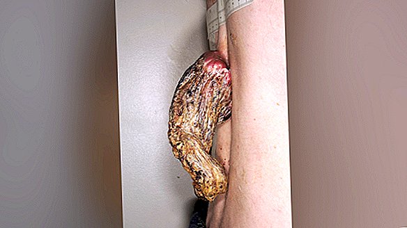 5 colių ilgio „Drakono ragas“ auga iš žmogaus nugaros