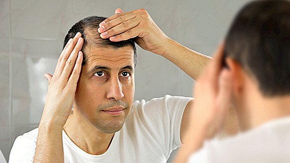 Hiustenlähtö: Hiustenlähtön ja kaljuuntumisen syyt, oireet ja hoidot