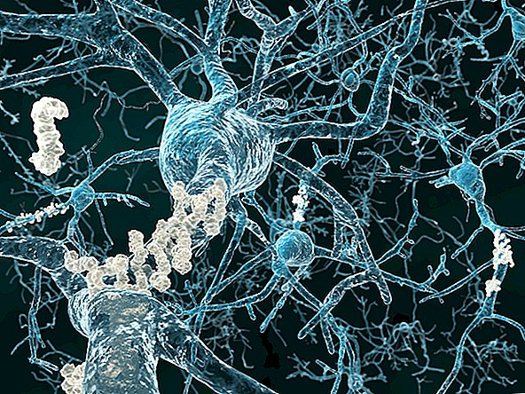 Maladie d'Alzheimer: changements cérébraux, symptômes et traitement