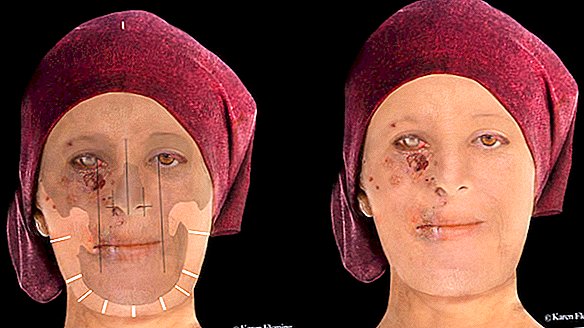 تظهر عمليات إعادة البناء الرقمية المذهلة امرأة اسكتلندية من القرن السادس عشر موبوءة بالجذام