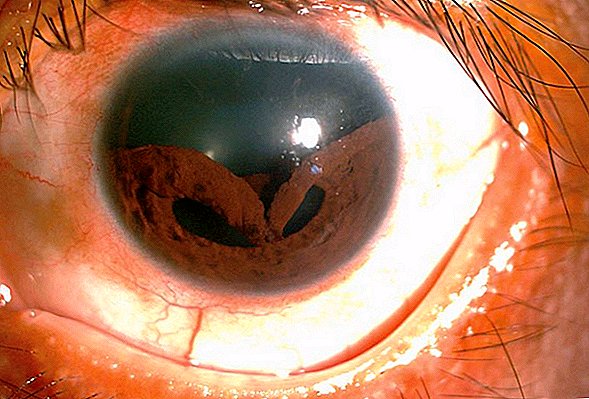 Una lesión en un ojo extraño causó el colapso del iris de un hombre