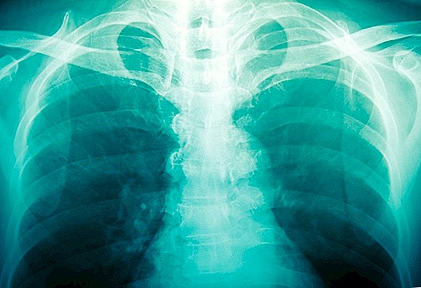 En røntgenbillede, der viser 100 boblete-perler i en teenagers underliv, har læger meget forvirret