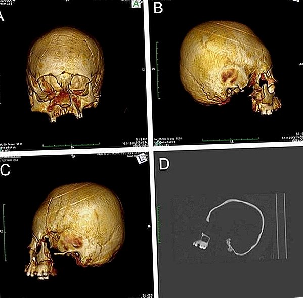 Senie skeleti ar citplanētiešiem līdzīgām galvām, kas nav izvietoti Horvātijā
