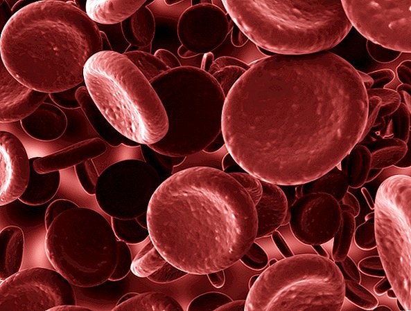 فقر الدم: الأسباب والأعراض والعلاج