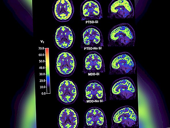 Los escáneres cerebrales revelan un biomarcador potencial de pensamientos suicidas en personas con TEPT