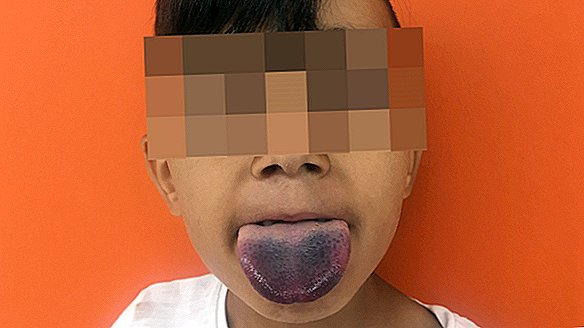 아이가 병에 걸린 혀를 얻었다. 의사는이 독창적 인 방법으로 해방했습니다