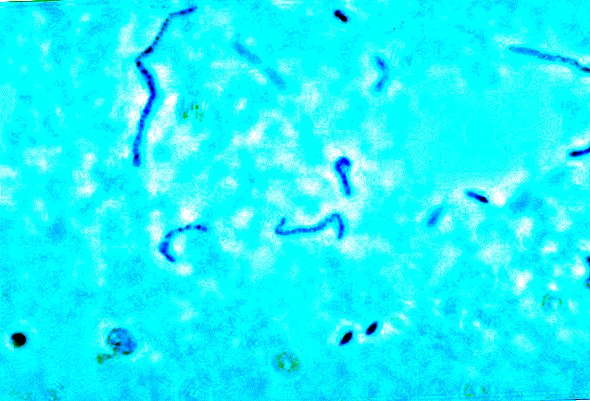Collegeatleet sterft aan zeldzame bacteriële ziekte genaamd 'Forgotten Disease'