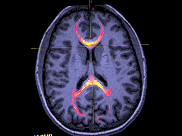 Hjärnskakningar skadar "bron" mellan hjärnans två halvor