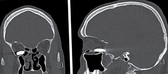No parpadee: la imagen llamativa muestra una bala en la cuenca del ojo del hombre