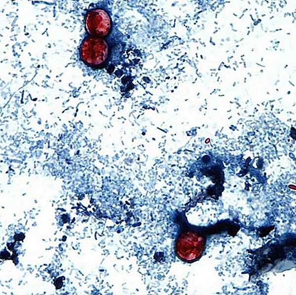 Des dizaines de personnes tombent malades lors d'une épidémie au Texas: qu'est-ce que la cyclospora?