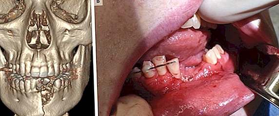 Une cigarette électronique explose dans la bouche d'un adolescent, se casse la mâchoire et se fait exploser les dents