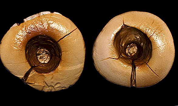 Tidigaste tandfyllningar upptäckt i 13 000 år gammalt skelett