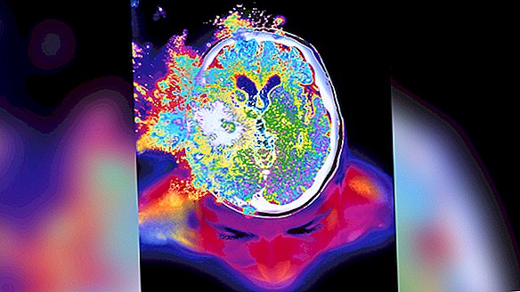 Elektriske 'stormer' og 'flashflom' drukner hjernen etter et hjerneslag