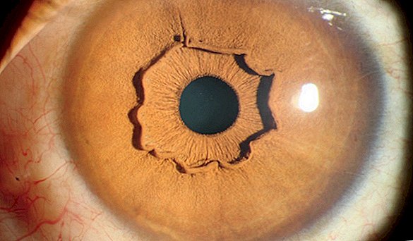 'Acs' nevar izskatīties: 9 acs ābola ievainojumi, kas liks jums savirzīties