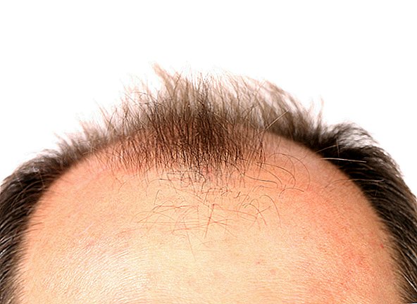 Médicament contre la croissance des cheveux lié à la dysfonction érectile qui dure des années