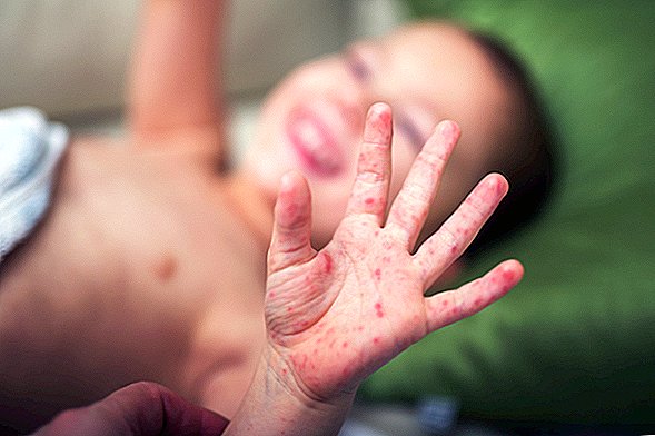 Maladie de la main, de la fièvre aphteuse: causes, symptômes et traitement