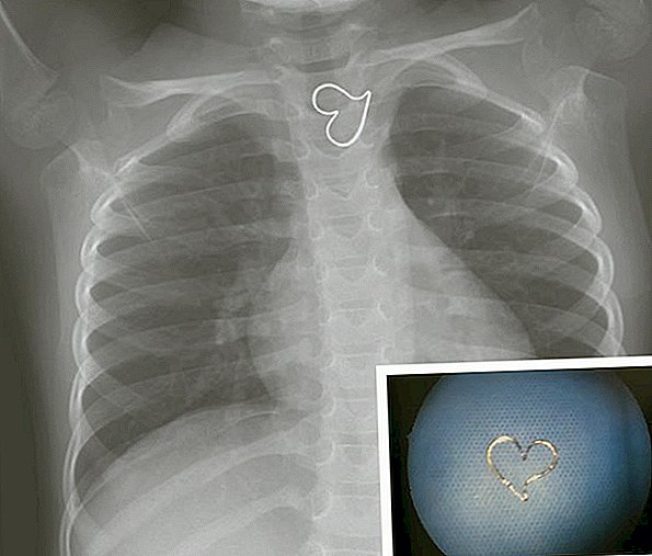 Ecco perché una forma di cuore perfetta si è presentata sulla radiografia di una ragazza