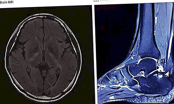 Comment les bosses sur les talons d'un homme ont signalé une maladie rare dans son cerveau
