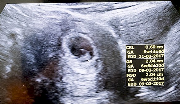 Un «rythme cardiaque fœtal» est-il vraiment un rythme cardiaque à 6 semaines?