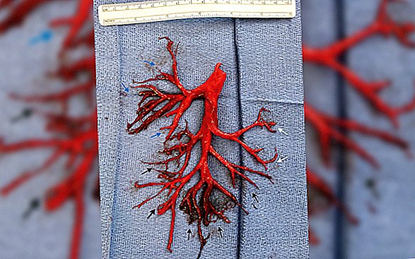 Der Mensch hustet ein riesiges Blutgerinnsel in Form seiner Lunge