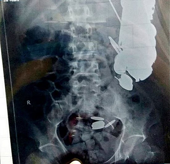 Mannen har kirurgi for å fjerne 263 mynter, 100 negler fra magen
