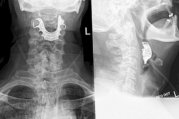 Dentarele unui bărbat au fost blocate în gâtul său mai mult de o săptămână