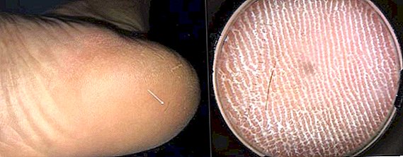 Kaki Kaki Manusia Adalah disebabkan oleh 'Splinter Hair'
