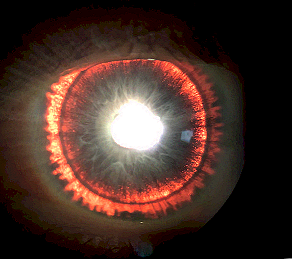 El iris 'resplandeciente' del hombre era un signo de síndrome de ojo raro