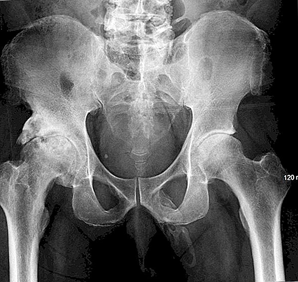De röntgenfoto van de mens onthult dat zijn penis in bot verandert