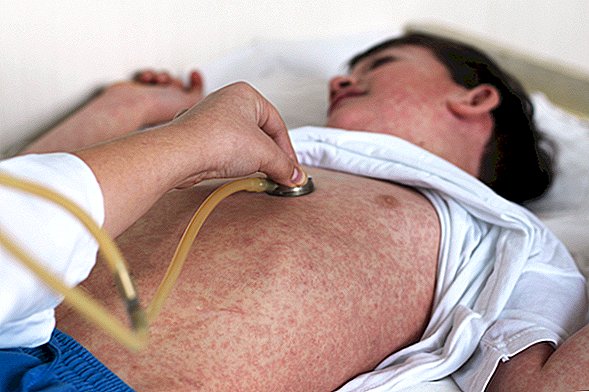 Morbillo: sintomi, trattamento e vaccinazione