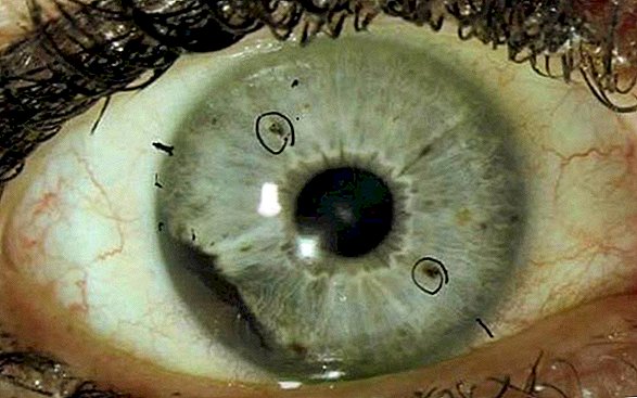 Paslaptingo akių vėžio atvejai iškyla 2 valstijose, ir gydytojai negali to paaiškinti