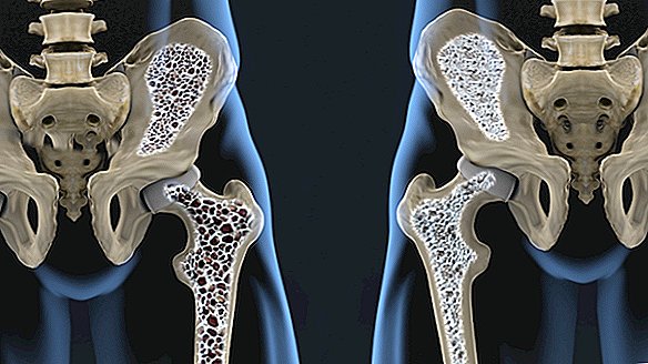 Osteoporose: riscos, sintomas e tratamento