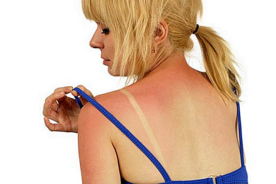 Science of Summer: Co způsobuje Sunburns?
