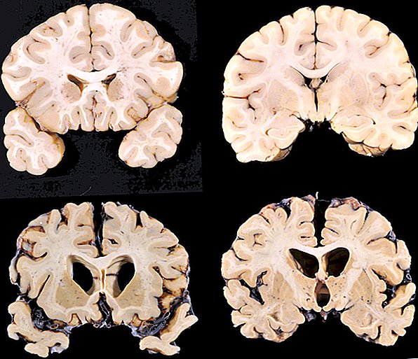 Упечатљива студија показује како фудбал утиче на мозак