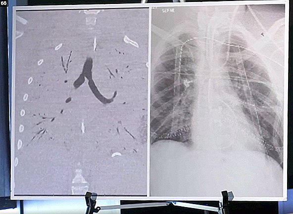Los pulmones de un adolescente estaban tan dañados por el vapeo que necesitaba un trasplante de doble pulmón