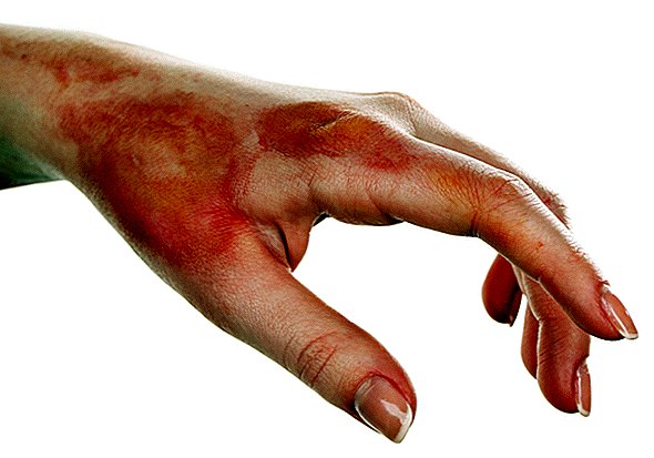 Denne 'limpistollignende' enheten skriver ut hud for å helbrede sår