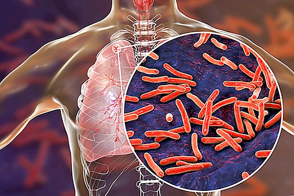 Tuberkuloze: simptomi, ārstēšana un profilakse