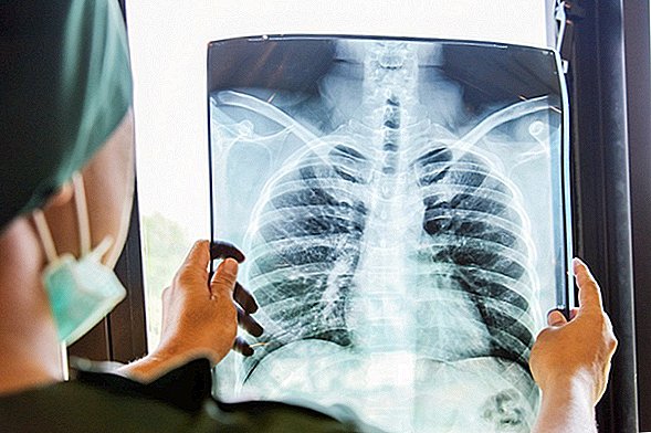 Vapingは「ポップコーン肺」として知られるまれな状態を引き起こす可能性がある、新しい症例報告が示唆している