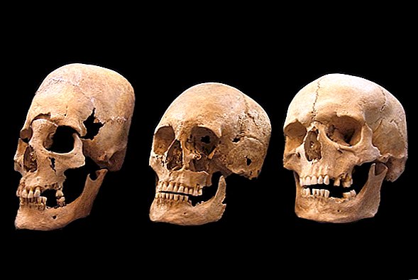 なぜこれらの中世ヨーロッパの女性にはエイリアンのような頭蓋骨があったのですか？