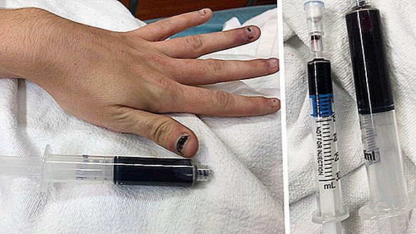 Kvinnens blod forvandler en chokerende skygge af blå, efter at hun brugte tand-numbing gel