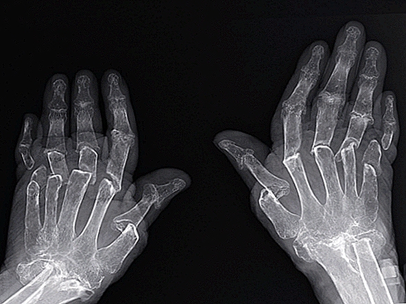 Huesos de mujer encogidos en caso raro de 'dedos telescópicos'
